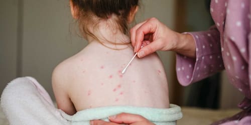 Florida seeks to remove 4 vaccines, including chickenpox, from school requirements