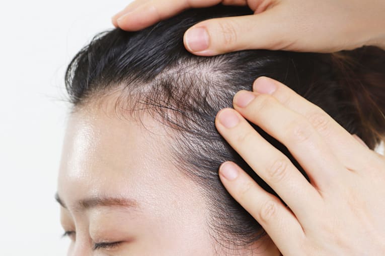 Before you panic about hair loss in your 20s, read this expert-backed breakdown
