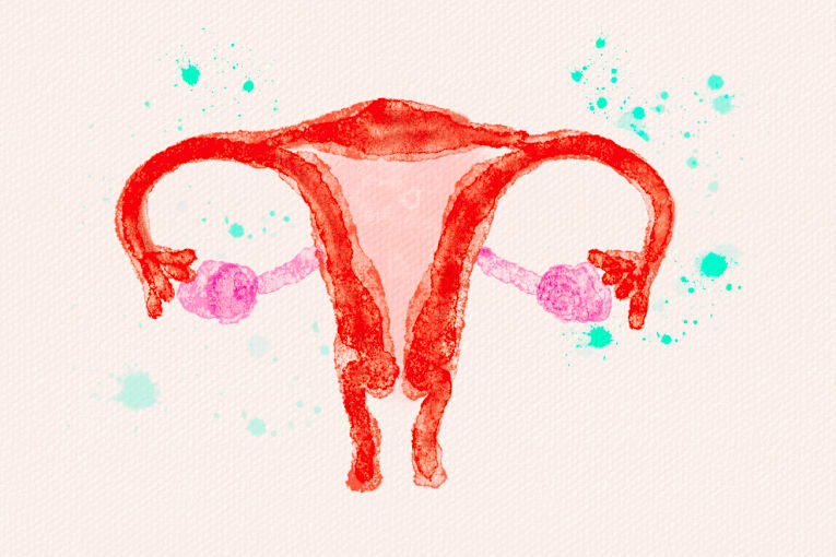 This simple procedure could prevent thousands of ovarian cancer deaths
