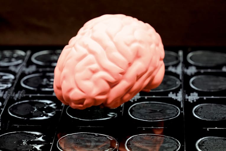 At least 1 in 4 ex-NFL players who died from 2016 to 2021 had CTE, study finds