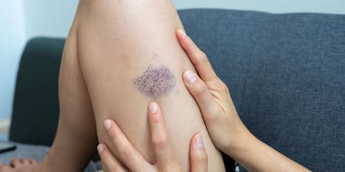 7 surprising reasons you bruise so easily, according to doctors
