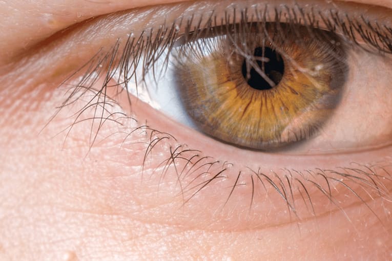 Those tiny white bumps around your eyes probably aren&rsquo;t acne